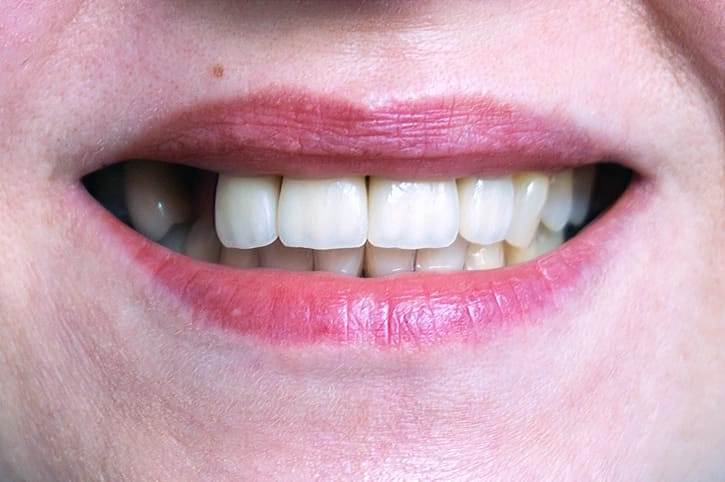 missing tooth